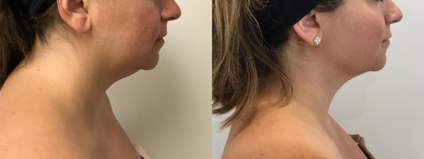 Before & After MyEllevate®/ MyEllevate® Plus Case 340 Right Side View in Barrington, Illinois