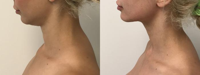 Before & After PrecisionTX® Case 169 Left Side View in Barrington, Illinois