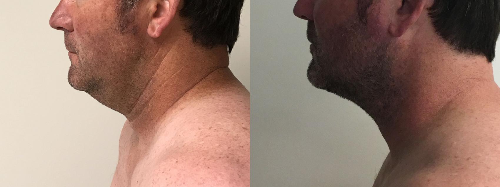 Before & After PrecisionTX® Case 175 Left Side View in Barrington, Illinois