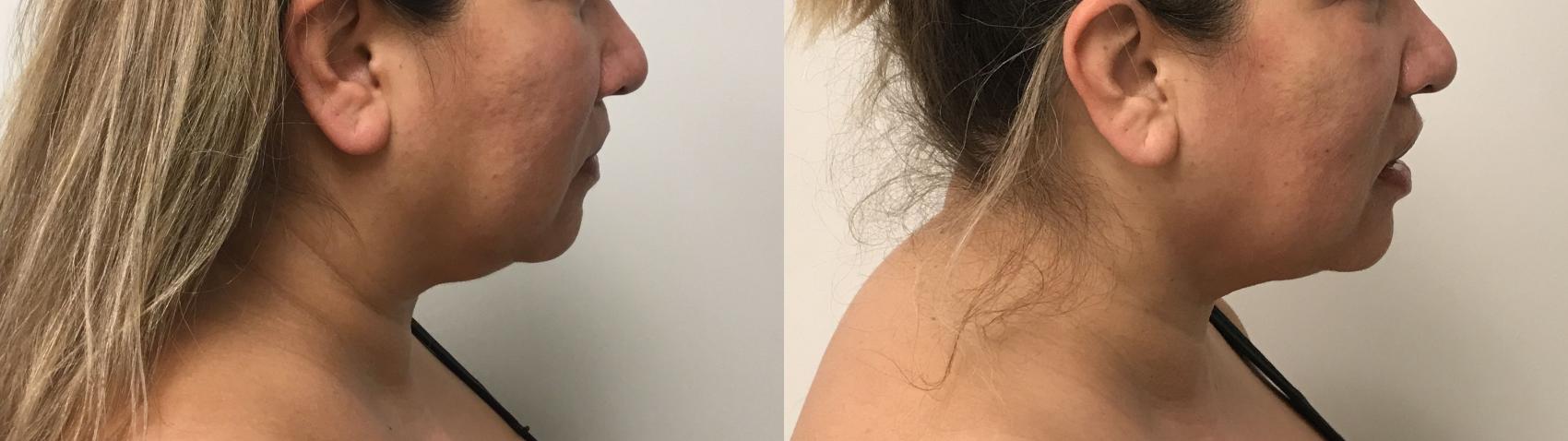 Before & After PrecisionTX® Case 233 Right Side View in Barrington, Illinois