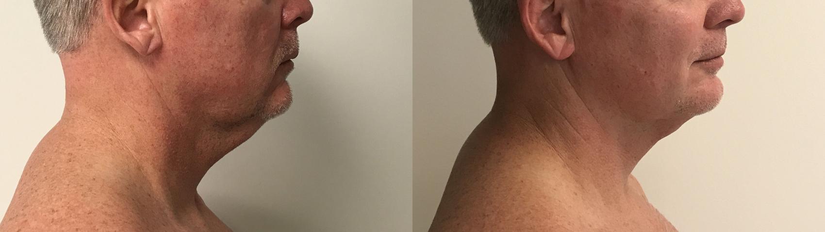 Before & After PrecisionTX® Case 235 Right Side View in Barrington, Illinois