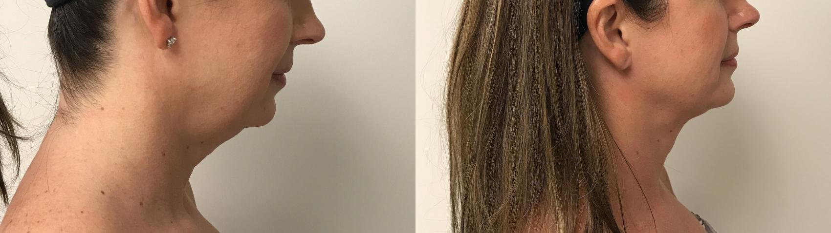 Before & After PrecisionTX® Case 242 Right Side View in Barrington, Illinois