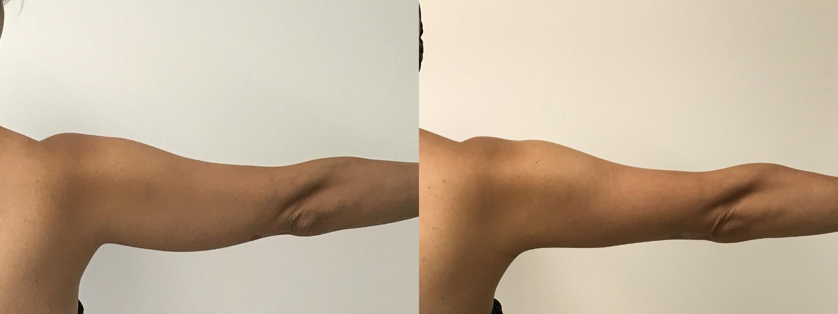 Before & After Smartlipo® Triplex Case 170 Back View in Barrington, Illinois
