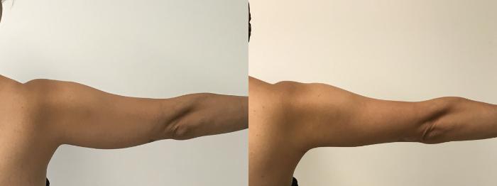 Before & After Liposuction Case 170 Back View in Barrington, Illinois