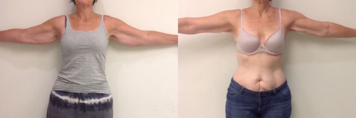 Before & After Smartlipo® Triplex Case 19 View #2 View in Barrington, Illinois