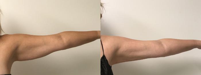 Before & After Liposuction Case 199 Front View in Barrington, Illinois