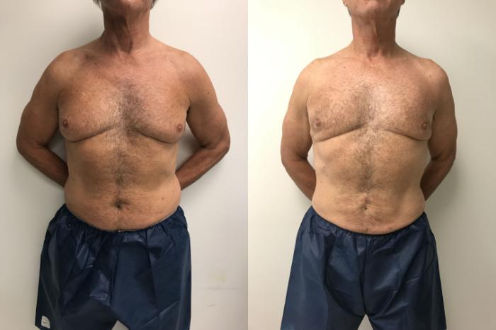 Before & After Smartlipo® Triplex Case 259 Front View in Barrington, Illinois