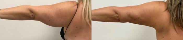Before & After Liposuction Case 363 Back View in Barrington, Illinois