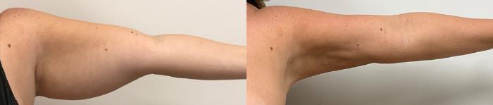 Before & After Liposuction Case 363 Front View in Barrington, Illinois