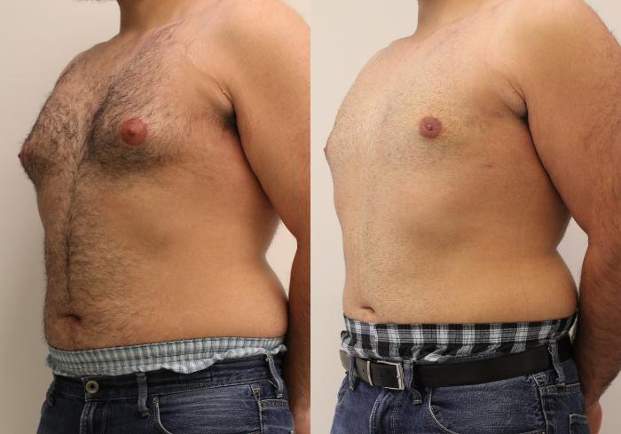 Before & After Smartlipo® Triplex Case 40 View #1 View in Barrington, Illinois