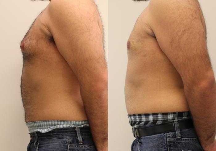 Before & After Smartlipo® Triplex Case 40 View #2 View in Barrington, Illinois