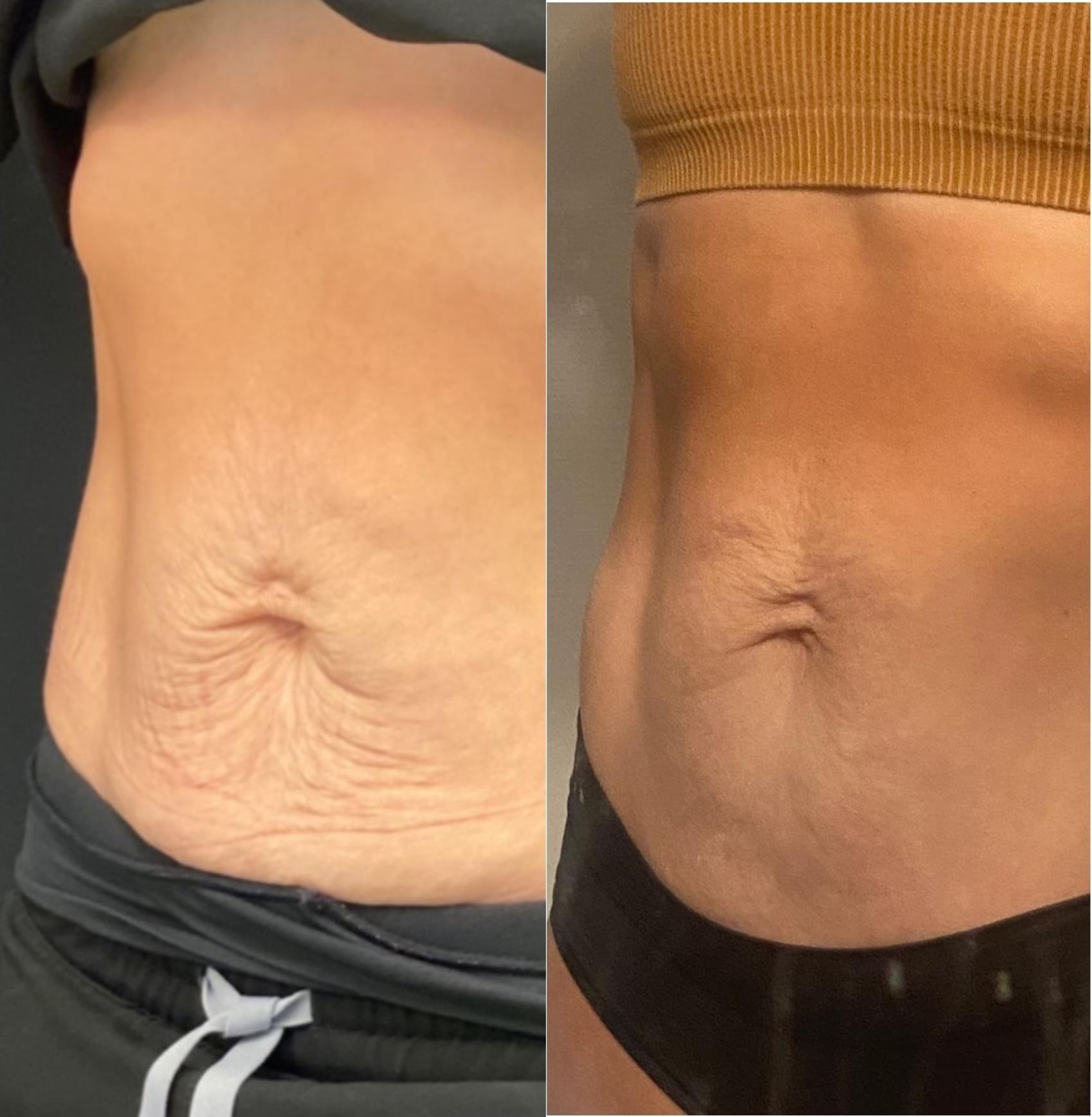 Before & After Sofwave™ Case 311 Left Oblique View in Barrington, Illinois