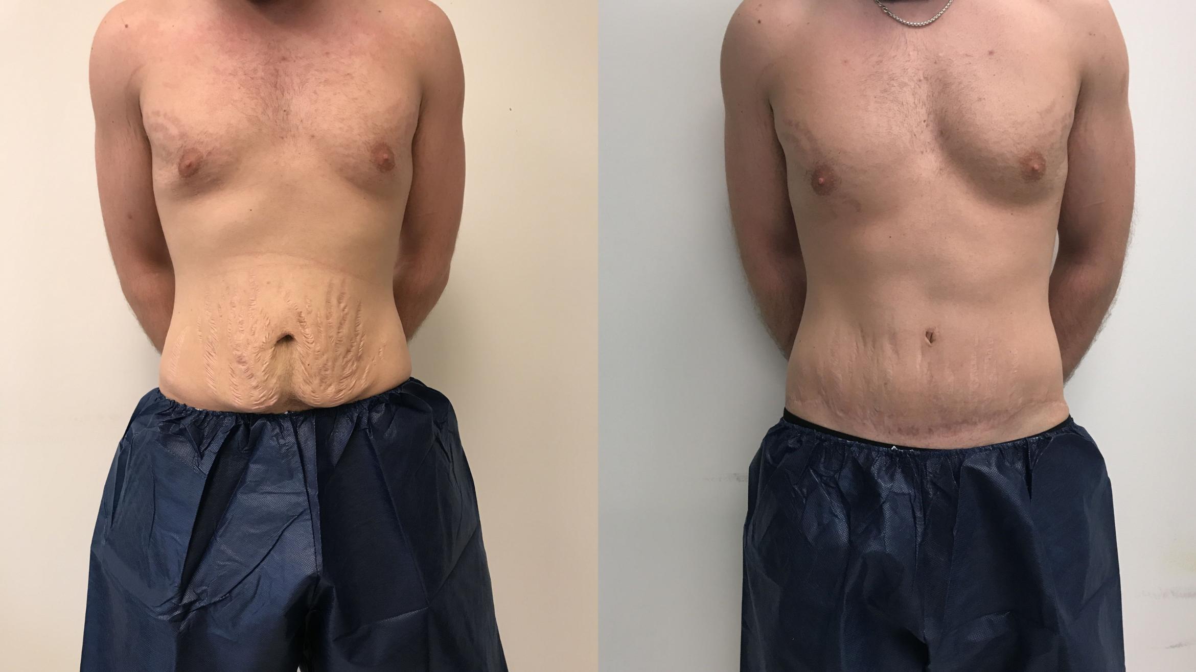 Before & After Tummy Tuck 360 Case 149 Front View in Barrington, Illinois