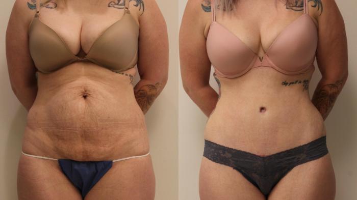 Before & After Tummy Tuck 360 Case 106 Front View in Barrington, Illinois