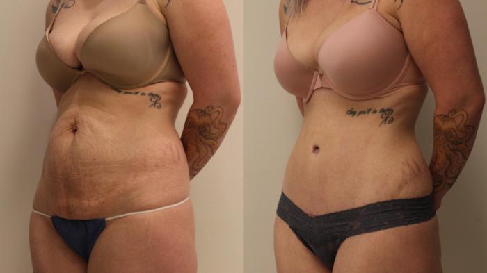 Before & After Tummy Tuck 360 Case 106 Left Oblique View in Barrington, Illinois