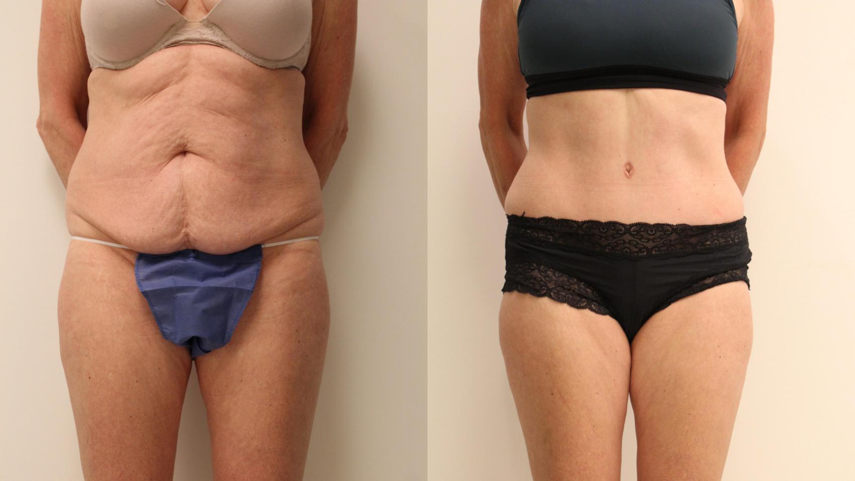 Before & After Tummy Tuck 360 Case 107 Front View in Barrington, Illinois