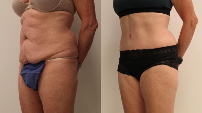 Before & After Tummy Tuck 360 Case 107 Left Oblique View in Barrington, Illinois