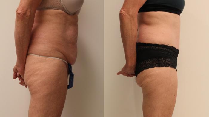 Before & After Tummy Tuck 360 Case 107 Right Side View in Barrington, Illinois