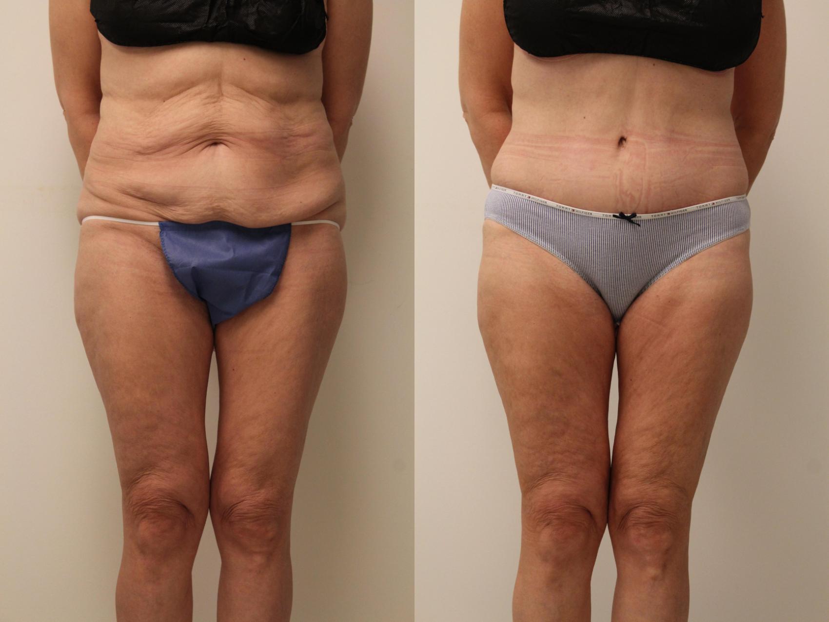Before & After Tummy Tuck 360 Case 118 Front View in Barrington, Illinois