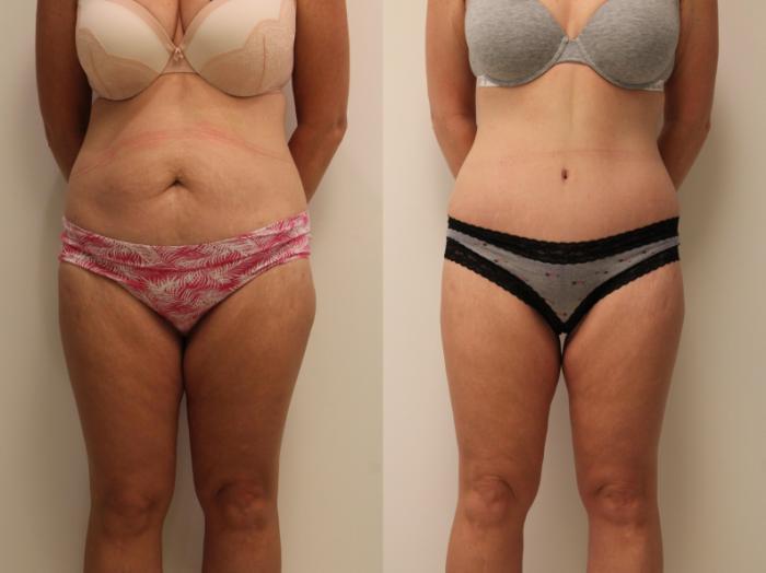 Tummy Tuck 360 Before and After Photo Gallery, Barrington, Illinois