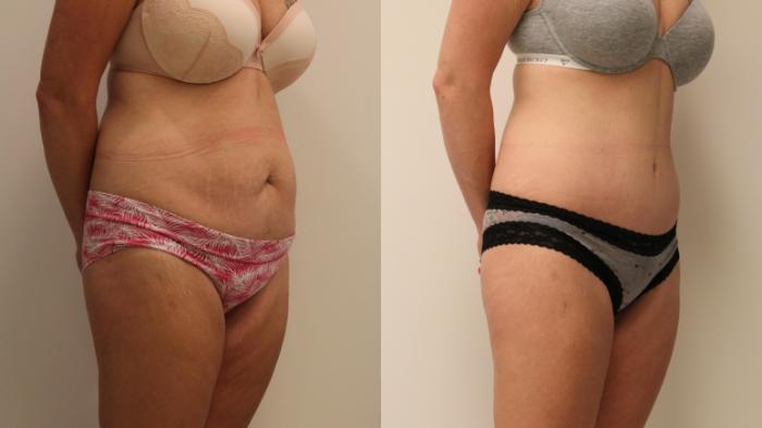 Before & After Tummy Tuck 360 Case 125 Right Oblique View in Barrington, Illinois