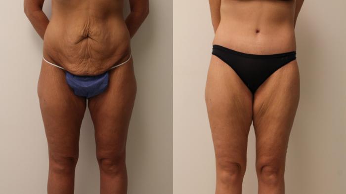 Before & After Tummy Tuck 360 Case 130 Front View in Barrington, Illinois