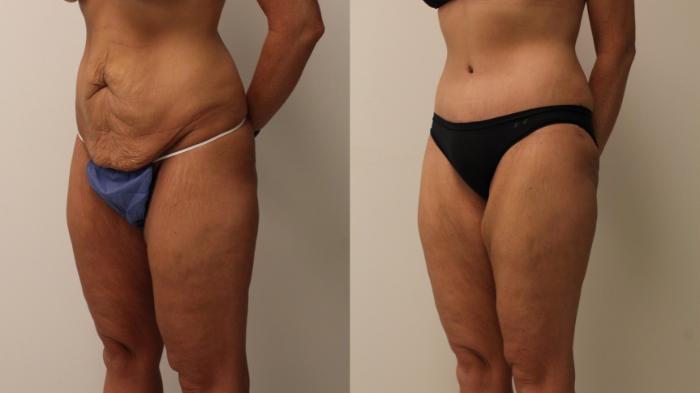 Before & After Tummy Tuck 360 Case 130 Left Oblique View in Barrington, Illinois