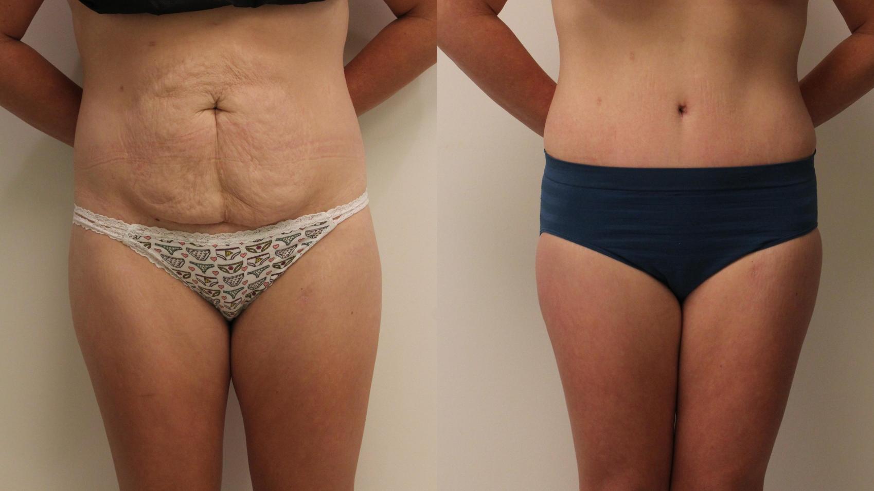 Before & After Tummy Tuck 360 Case 132 Front View in Barrington, Illinois