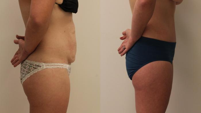Before & After Tummy Tuck 360 Case 132 Right Side View in Barrington, Illinois