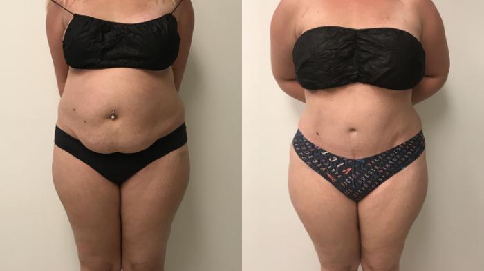 Before & After Tummy Tuck 360 Case 147 Front View in Barrington, Illinois
