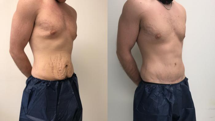 Before & After Tummy Tuck 360 Case 149 Right Oblique View in Barrington, Illinois
