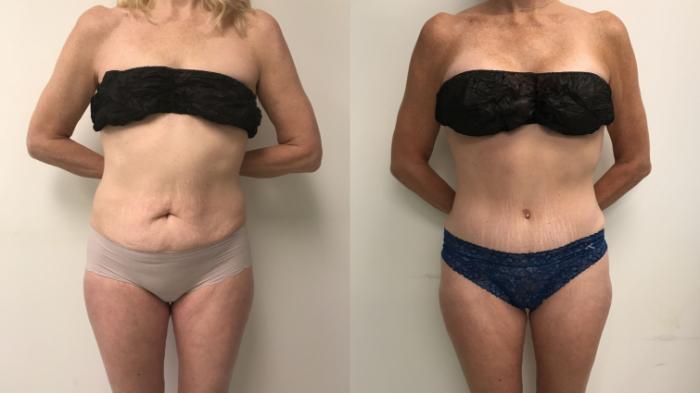 Before & After Tummy Tuck 360 Case 152 Front View in Barrington, Illinois