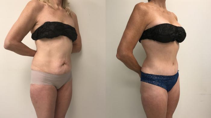 Before & After Tummy Tuck 360 Case 152 Right Oblique View in Barrington, Illinois