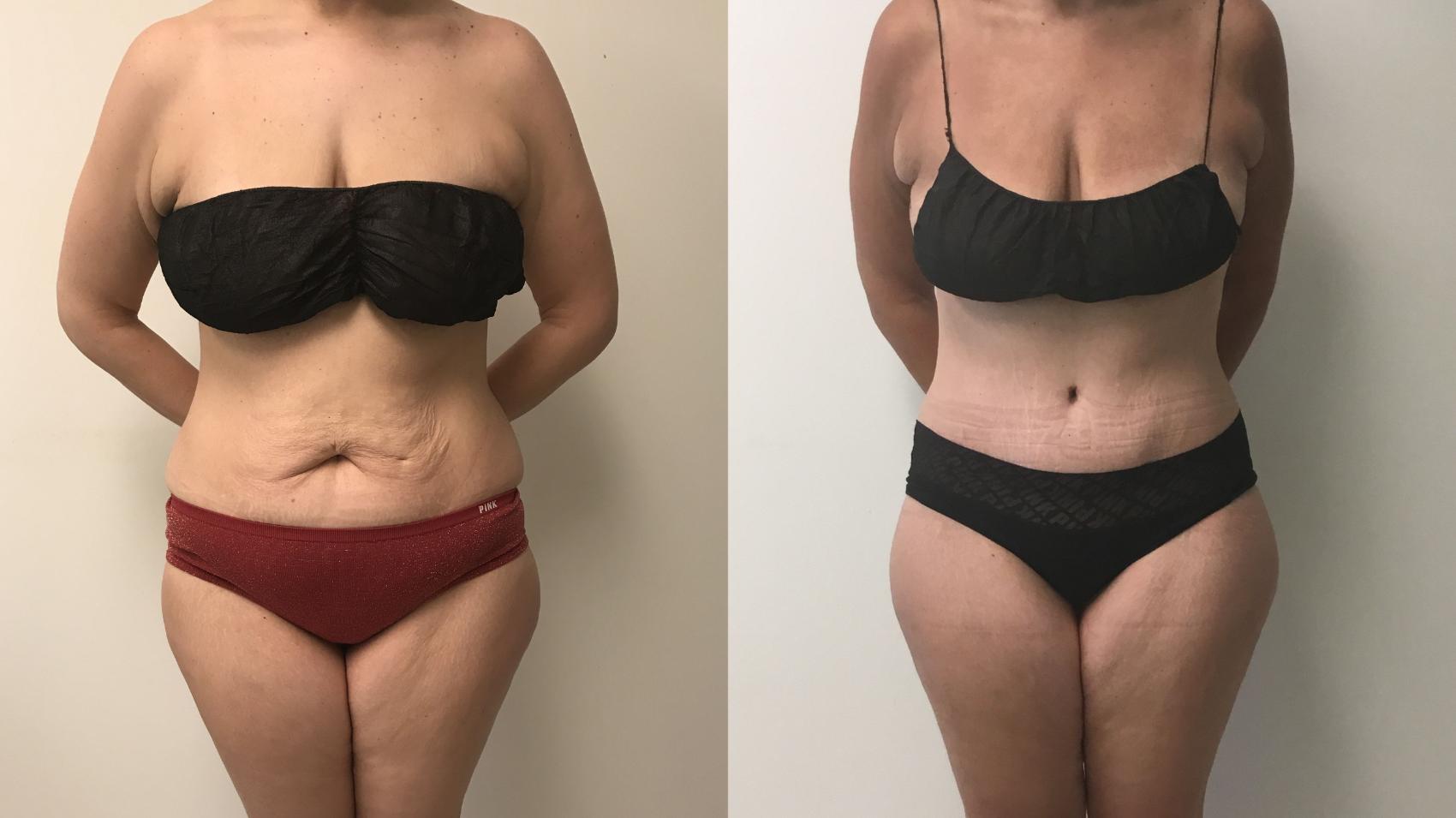 Before & After Tummy Tuck 360 Case 156 Front View in Barrington, Illinois