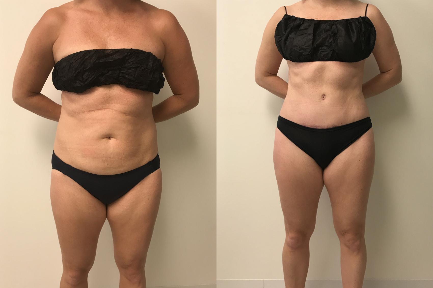 Before & After Tummy Tuck 360 Case 180 Front View in Barrington, Illinois
