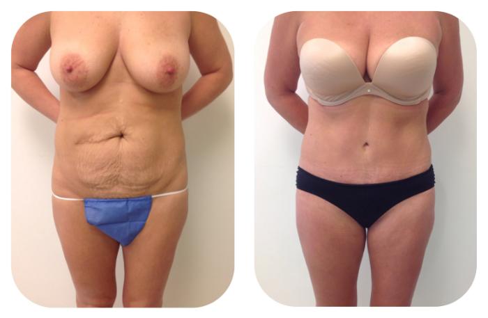 Before & After Tummy Tuck 360 Case 20 View #1 View in Barrington, Illinois