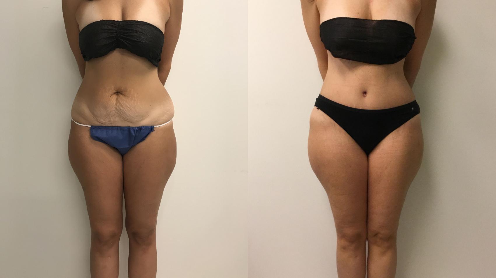 Before & After Tummy Tuck 360 Case 202 Front View in Barrington, Illinois