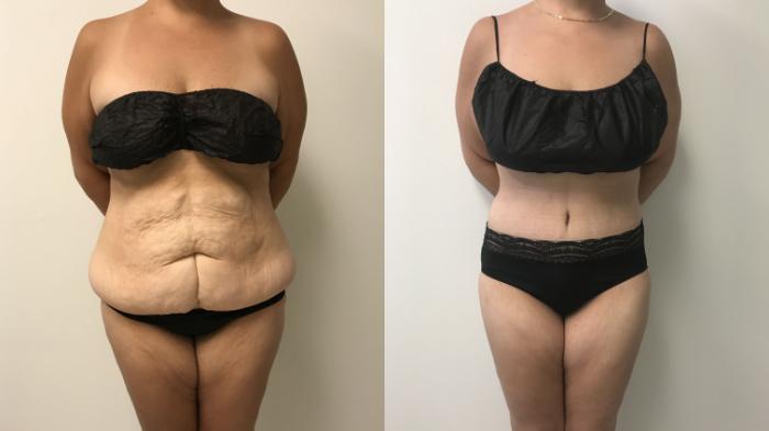 Before & After Tummy Tuck 360 Case 212 Front View in Barrington, Illinois