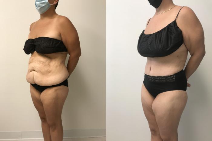 Before & After Tummy Tuck 360 Case 212 Left Oblique View in Barrington, Illinois
