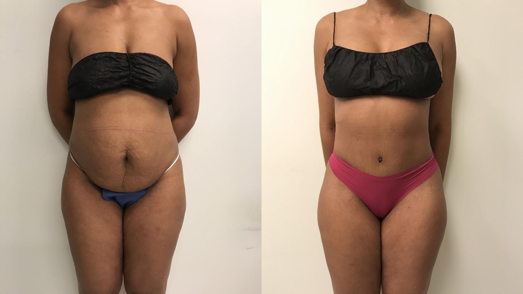 Before & After Tummy Tuck 360 Case 214 Front View in Barrington, Illinois
