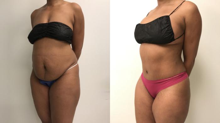 Before & After Tummy Tuck 360 Case 214 Left Oblique View in Barrington, Illinois