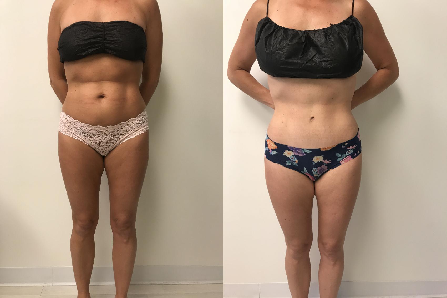Before & After Tummy Tuck 360 Case 229 Front View in Barrington, Illinois