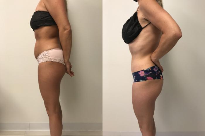 Before & After Tummy Tuck 360 Case 229 Left Side View in Barrington, Illinois