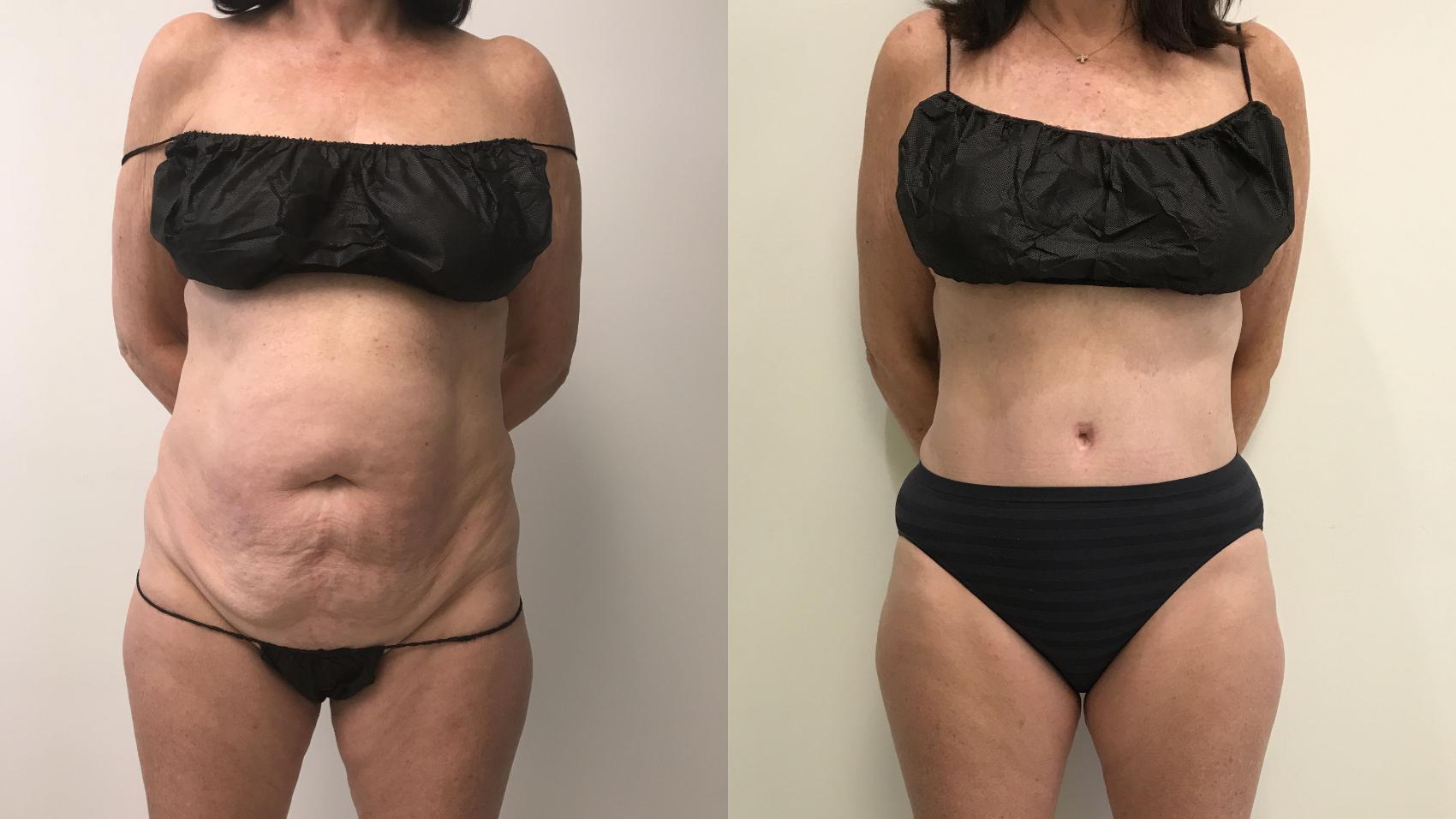 Before & After Tummy Tuck 360 Case 243 Front View in Barrington, Illinois