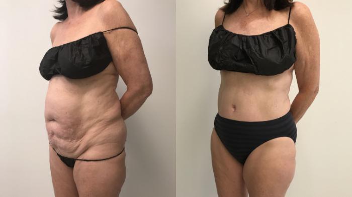 Before & After Tummy Tuck 360 Case 243 Right Oblique View in Barrington, Illinois