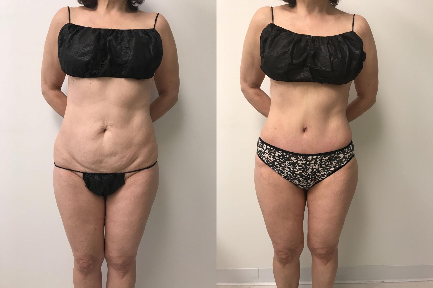 Before & After Tummy Tuck 360 Case 245 Front View in Barrington, Illinois
