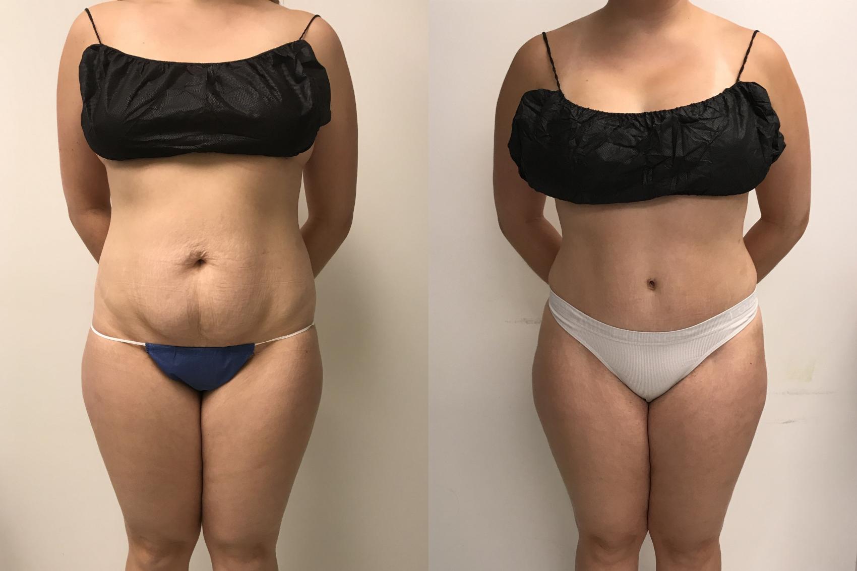 Before & After Tummy Tuck 360 Case 262 Front View in Barrington, Illinois