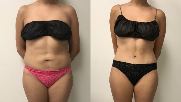 Before & After Tummy Tuck 360 Case 264 Front View in Barrington, Illinois