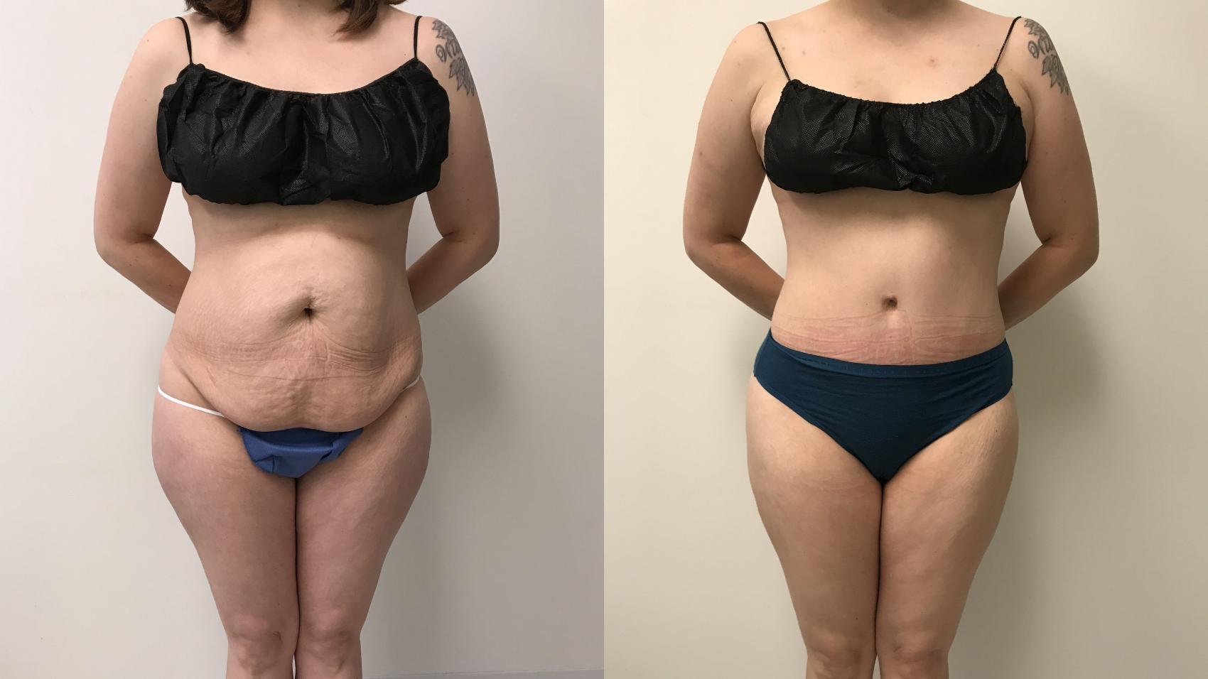 Before & After Tummy Tuck 360 Case 266 Front View in Barrington, Illinois