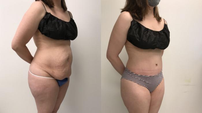 Before & After Tummy Tuck 360 Case 266 Right Oblique View in Barrington, Illinois